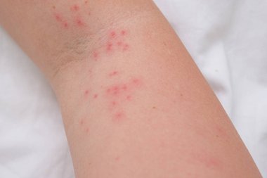 Kadın kolunda deri kızarıklığı alerjik reaksiyon, tepki, alerji ve dermatoloji konsepti sonucu kaşınan sivilceler.