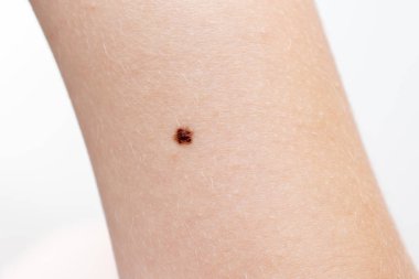 Nevus, bir kolun derisinde neoplazma, dermatoloji ve onkoloji tedavisi ve ameliyat.