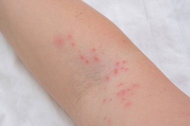 Kadın kolunda deri kızarıklığı alerjik reaksiyon, tepki, alerji ve dermatoloji konsepti sonucu kaşınan sivilceler.
