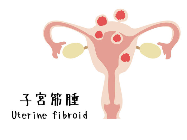 Illustration showing types of uterine fibroids