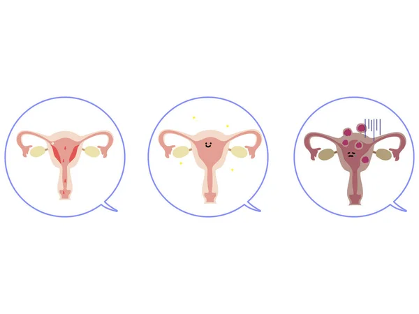 Illustrazione Utero Fibromi Sani — Vettoriale Stock