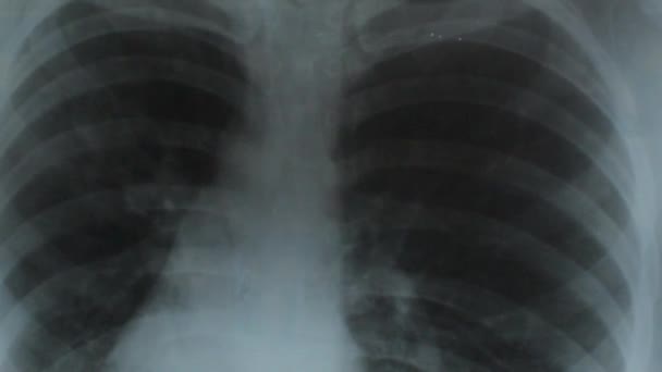 Ιατρός Βλέπε Διαγνωστική Ανάλυση Πνευμονικό Ray Center Πνευμονία Στους Πνεύμονες — Αρχείο Βίντεο