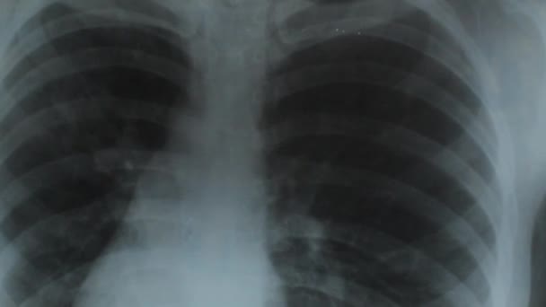 医生见诊断分析肺X光中心 病人肺部的肺炎影像 — 图库视频影像
