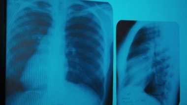 COVID-19. Akciğerlerde zatürree var. Bir hastanın görüntüsünde. Tıp doktoru. Teşhis Analizi 'ne bakın. X-ray merkezi.