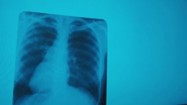 COVID-19. Akciğerlerde zatürree var. Bir hastanın görüntüsünde. Tıp doktoru. Teşhis Analizi 'ne bakın. X-ray merkezi.