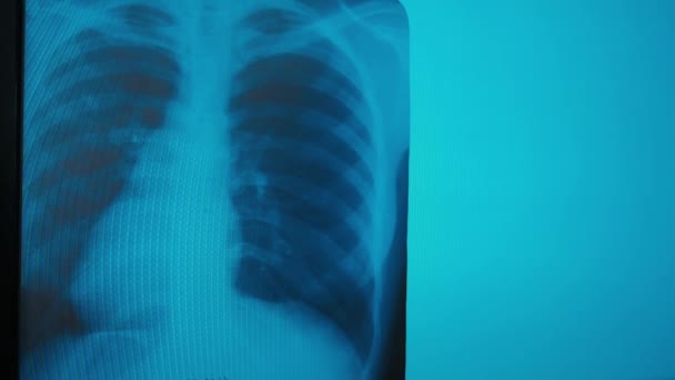 Covid 肺气肿是以病人形象出现的 医学博士 见诊断分析 X光中心 — 图库视频影像