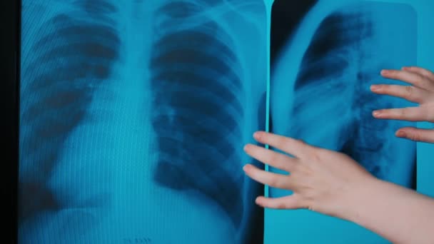 Covid Pneumonia Nos Pulmões Imagem Paciente Doutor Medicina Ver Análise — Vídeo de Stock