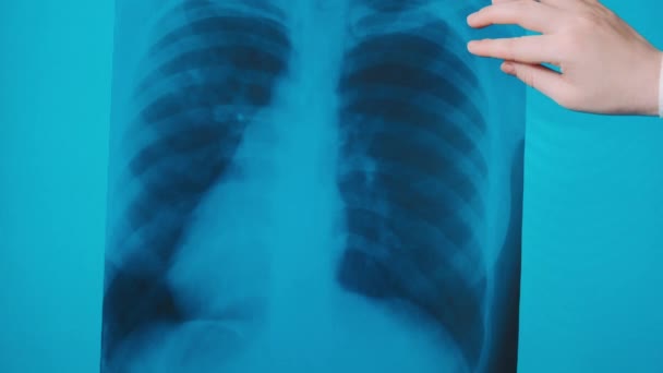 Covid Pneumonia Lungs Image Patient Doctor Medicine See Diagnostic Analysis — Stock Video