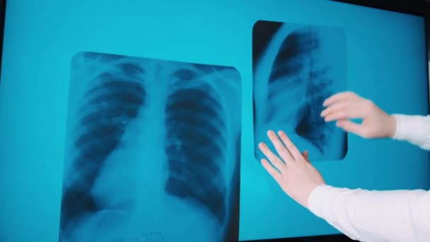 Covid Pneumonie Plicích Obrazu Pacienta Doktor Medicíny Viz Diagnostická Analýza — Stock video