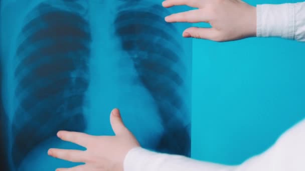 Covid Пневмонія Легенях Зображенні Пацієнта Доктор Медицини Див Діагностичний Аналіз — стокове відео