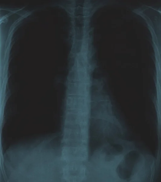 Humano Luz Torácica Ultra Som Radiografia Teste Medicina — Fotografia de Stock