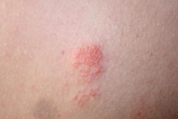 Тест Алергію Внутрішньовенний Тест — стокове фото