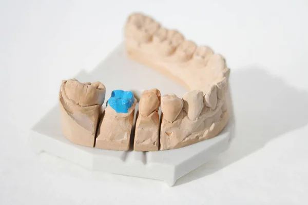 牙齿44和45都可以被移除以进行更好的建模 — 图库照片