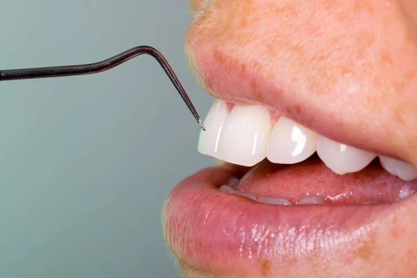 プローブで歯の制御 — ストック写真
