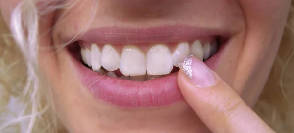 Zbliżenie Zębów Kobiety Aparatem Zęby — Zdjęcie stockowe