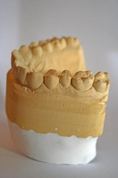 Tannavstøpning Tannlegetann – stockfoto