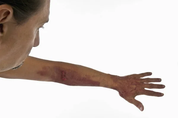 Nahaufnahme Der Männlichen Hand Mit Schmerzen Vor Weißem Hintergrund — Stockfoto