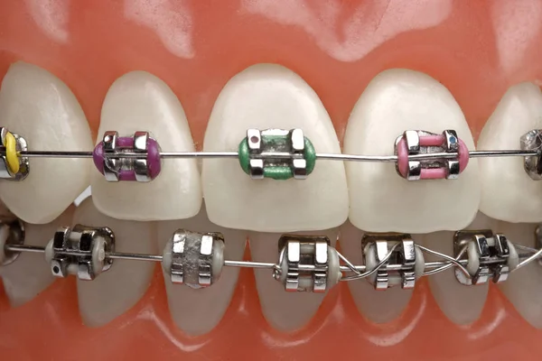 Implante Dental Dientes Para Los Dentistas —  Fotos de Stock