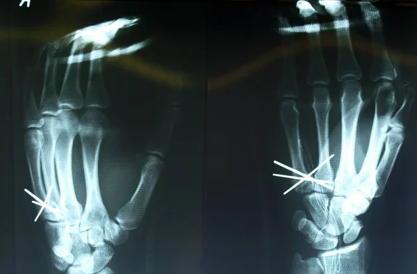 Röntgenbild Hand Med Tråd Gips — Stockfoto
