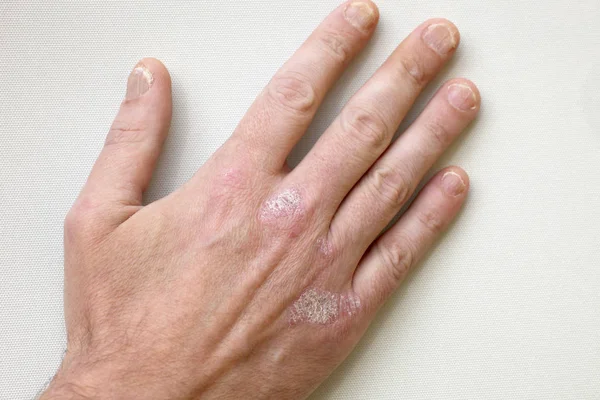 Psoriasis Psoriasis Hands Fingernails — Stock Photo, Image