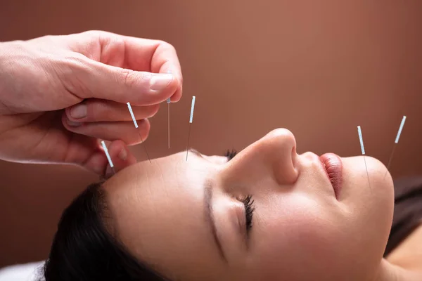 Close Woman Face Receiving Acupuncture Treatment Her Face Spa — Stock Photo, Image