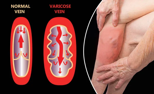 Åderbråck Ett Seniorben Kollage Strukturen Normala Och Åderbråck — Stockfoto