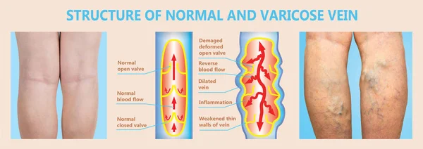 Varicose veins on a female senior legs. The structure of normal and varicose veins. Concept of dry skin, old senior people, varicose veins and deep vein thrombosis or DVT
