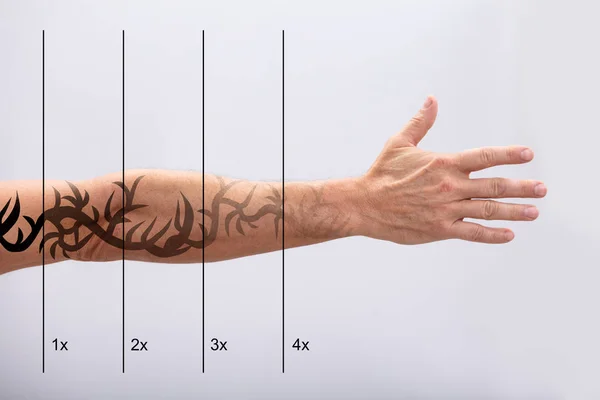 Laser Tattoo Poistaminen Miehen Käsi Valkoisella Taustalla — kuvapankkivalokuva