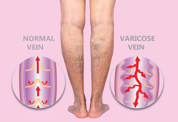 Varicose Veins Vein Thrombosis — Stock Photo, Image