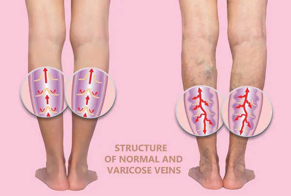 Varicose Veins Female Senior Legs Structure Normal Varicose Veins Concept — Stock Photo, Image