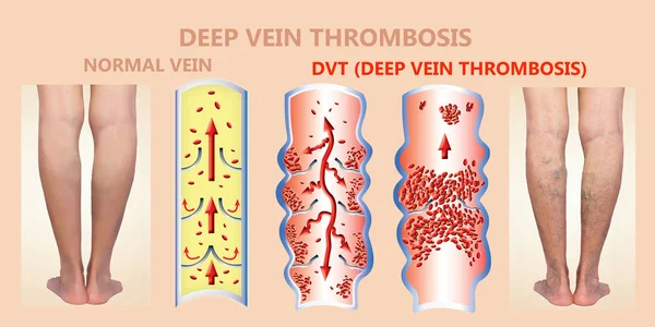 Deep Vein Thrombosis Blood Clots Embolus Structure Normal Varicose Female — Stock Photo, Image