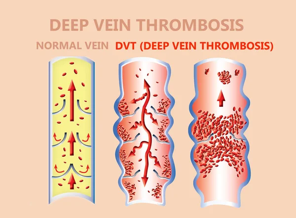 Thrombosis Normal Blood Flow Blood Clot Formation Clot Travels Bloodstream — Stock Photo, Image