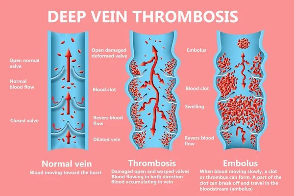 血栓形成Thrombosis 从正常的血液流动到血凝块形成和血凝块 通过血液流动 象牙海岸 医疗和科学用途说明 — 图库照片