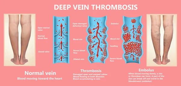 Thrombosis Normal Blood Flow Blood Clot Formation Clot Travels Bloodstream — Stock Photo, Image