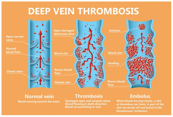 Thrombosis Normal Blood Flow Blood Clot Formation Clot Travels Bloodstream — Stock Photo, Image