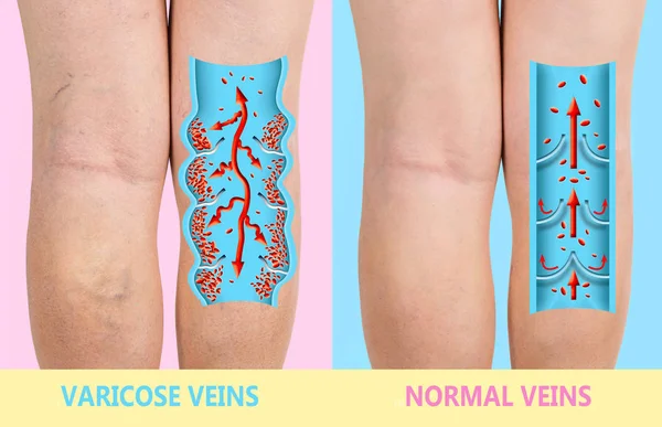 Варикозне Розширення Вен Жіночих Ногах Структура Нормальних Варикозних Вен Концепція — стокове фото