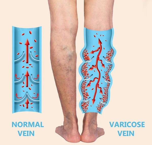 Варикозне Розширення Вен Жіночих Ногах Структура Нормальних Варикозних Вен Концепція — стокове фото