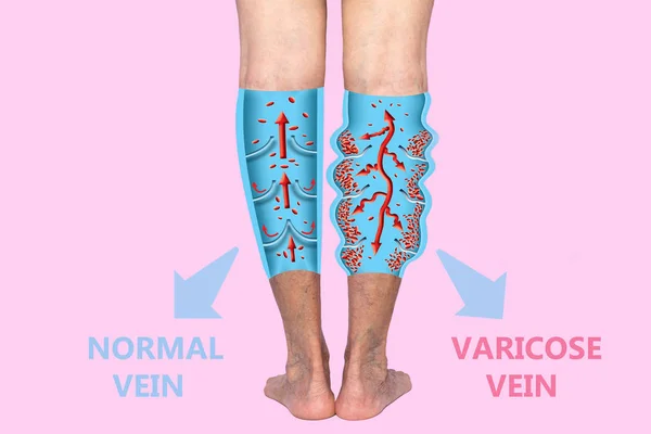 Варикозне Розширення Вен Жіночих Ногах Структура Нормальних Варикозних Вен Концепція — стокове фото