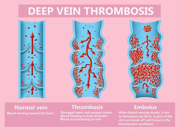 血栓形成Thrombosis 从正常的血液流动到血凝块形成和血凝块 通过血液流动 象牙海岸 医疗和科学用途说明 — 图库照片