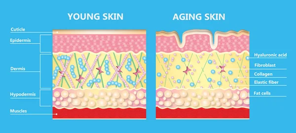 The diagram of younger skin and aging skin showing the decrease in collagen and broken elastin in older skin.