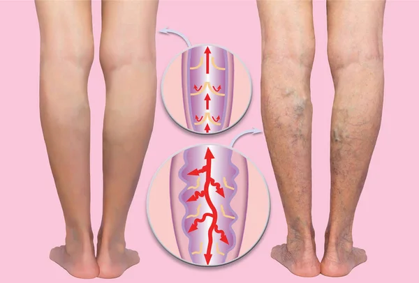 雌性长腿上的静脉曲张正常和静脉曲张的结构 干性皮肤 老年人 静脉曲张和深静脉血栓形成或Dvt的概念 — 图库照片