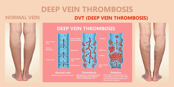 Trombose Veia Profunda Fendas Sangue Embolus Estrutura Das Veias Femininas — Fotografia de Stock