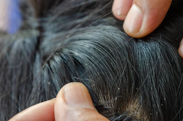 Louse Egg Hair Causes Itchy Head — Stock Photo, Image