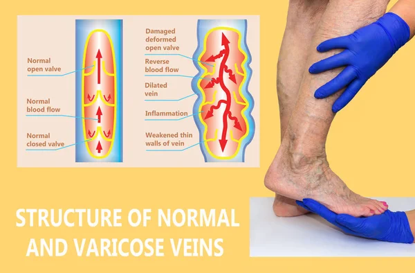 Varicose Veins Female Senior Legs Structure Normal Varicose Veins Concept — Stock Photo, Image