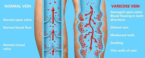 여자의 다리에 정맥류와 정맥류 정맥의 구조입니다 정맥류 혈전증 Dvt — 스톡 사진