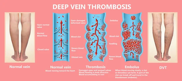 Deep Vein Thrombosis Blood Clots Embolus Structure Normal Varicose Female — Stock Photo, Image