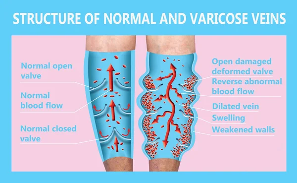 Vene Varicose Trombosi Venosa — Foto Stock