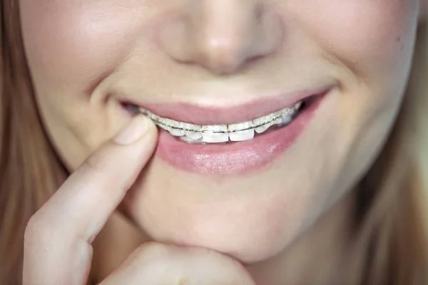 ブレース 審美的な歯科 健康と歯科ケアの現代的な固定と10代の女の子の美しい笑顔のクローズアップ写真 — ストック写真