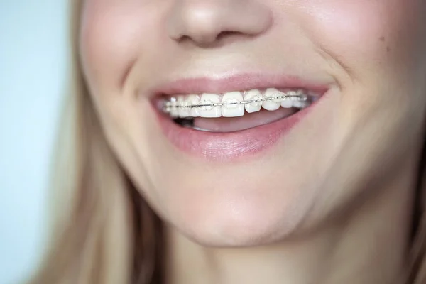 Aparat Ortodontyczny Zabieg Krzywe Zęby Zdjęcie Bliska Pięknego Uśmiechu Młodej — Zdjęcie stockowe