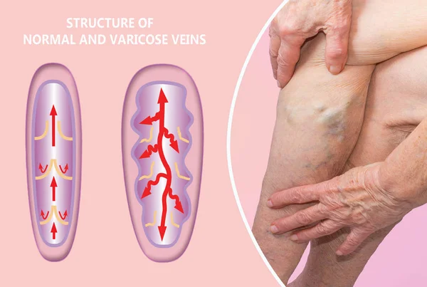 雌の上肢の静脈瘤 正常静脈と静脈瘤の構造 乾燥肌の概念 高齢者 静脈瘤や深部静脈血栓症やDvt — ストック写真